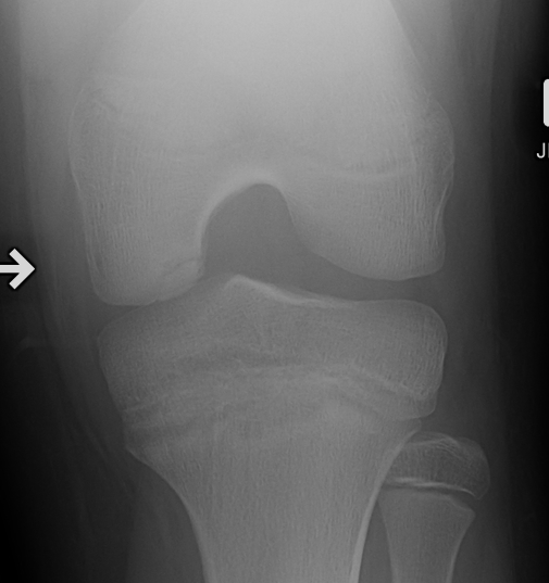 Knee OCD Rosenberg View